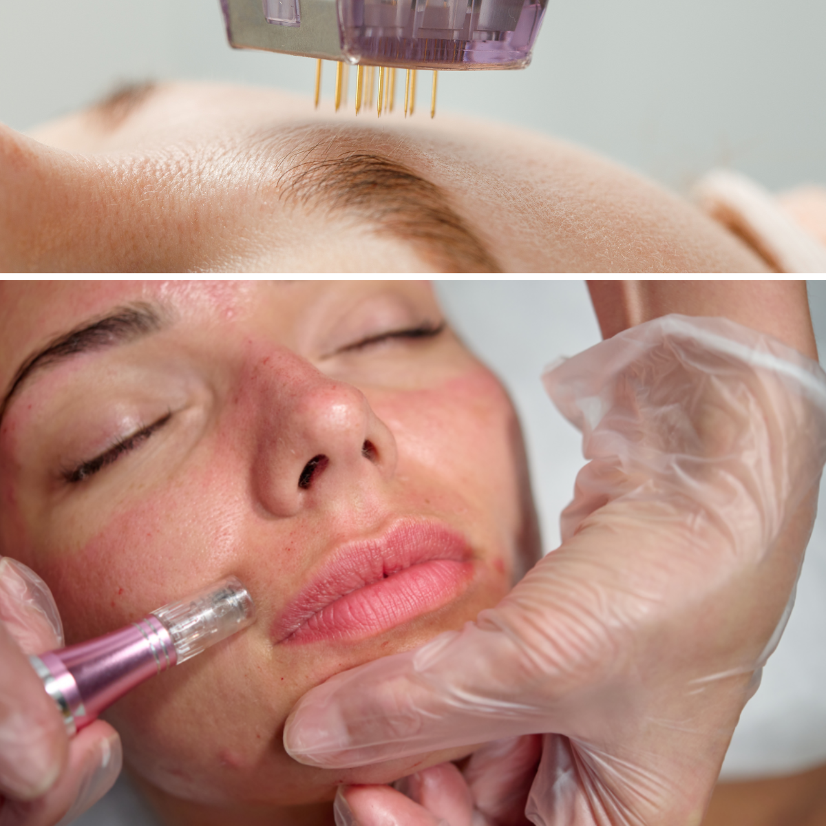 Microneedling Facial - Tratamiento de rejuvenecimiento con microagujas